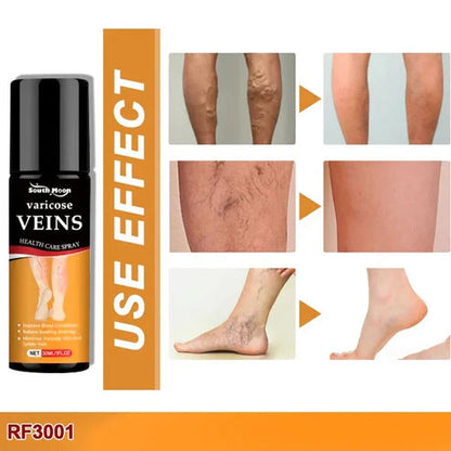 SmartHeal™ VARICOSE VEINS RELIEF SPRAY (BUY 1 GET 1 FREE)